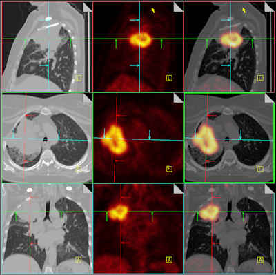 Non Small Cell Lung Cancer Staging