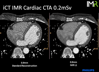 0.2-mSV cardiac CT angiography examination 