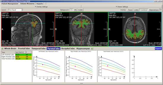 Fully automated segmentation and quantification of different brain regions based on a machine learning algorithm