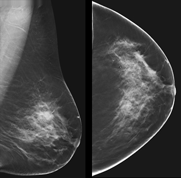 A 63-year-old woman with a subtle spiculated mass that is better demonstrated on tomosynthesis