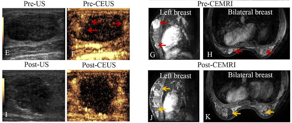 Additional images showing technical success of microwave ablation in a 20-year-old woman with eight fibroadenoma in bilateral breast