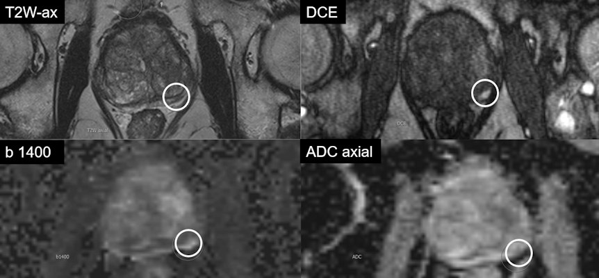 Multiparametric MRI of 74-year-old patient with a PSA of 9.6