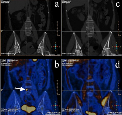 PET/CT images from a 53-year-old woman with breast cancer in the course of therapy but with rising biomarkers