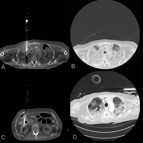 A series of annotated CT images of COVID-19 patients