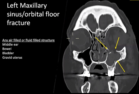 CT shows maxillary sinus fracture from blast and infilling of blood