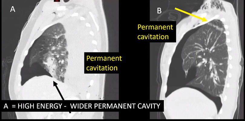 Patient A has high energy wound with wide cavity. In patient B, the cavity is narrower and the bullet is lodged posteriorly