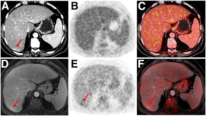 Indeterminate lesion on PET/CT classified by PET/MRI for 53-year-old man with lung cancer