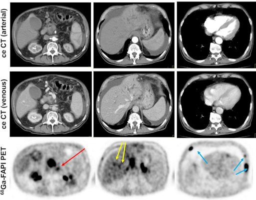 Contrast-enhanced CT and FAPI-PET/CT images from the same patient with local disease recurrence