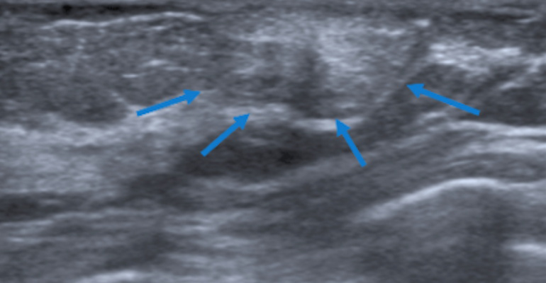 Ultrasound image shows the enhancement asymmetry corresponds to well-defined hyperechogenic nodule