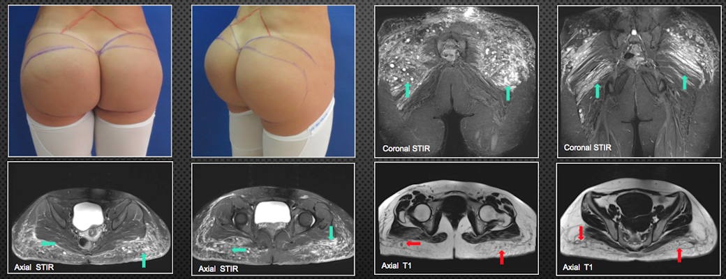 A 29-year-old patient was injected with biopolymers in the gluteal region six years ago to increase volume
