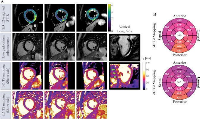 Cardiac MRI scans of a 41-year-old male with suspected cardiac sarcoidosis
