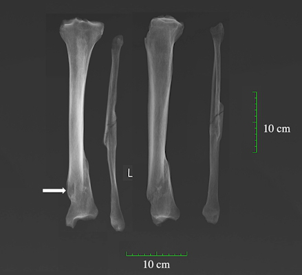 X-ray of antemortem spiral fracture of the tibia and fibula complicated by osteomyelitis on an adult male from the Hospital of St John, Cambridge