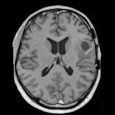 The UK publishes a best practice report on brain tumor images