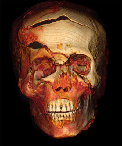 3D CT image of head of Seqenenre in frontal projection showing multiple craniofacial injuries: a gaping fracture of the frontal bone