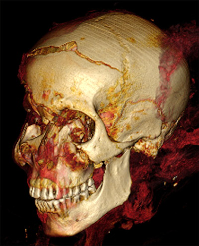 3D CT image of Seqenenre