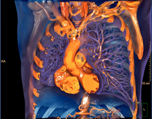 Philips has included new AI algorithms on IntelliSpace Portal 12 designed to detect lung nodules, analyze cardiac function, and quantify pulmonary infiltrates