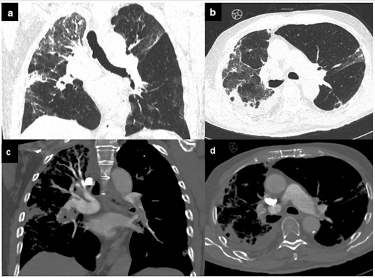 Pulmonary embolism. COVID-19 patient with dyspnea, increased D-dimer levels, and oxygen saturation. Chest CT evidenced ground-glass opacity with interstitial thickening of the interlobular and intralobular septa, together with pleural effusion