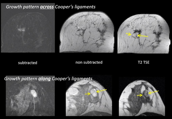 Radiologists should check for tumor growth in relation to Cooper