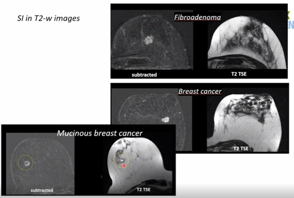 Benign tumors have higher signal on T2-weighted images, with the exception of mucinous breast cancer