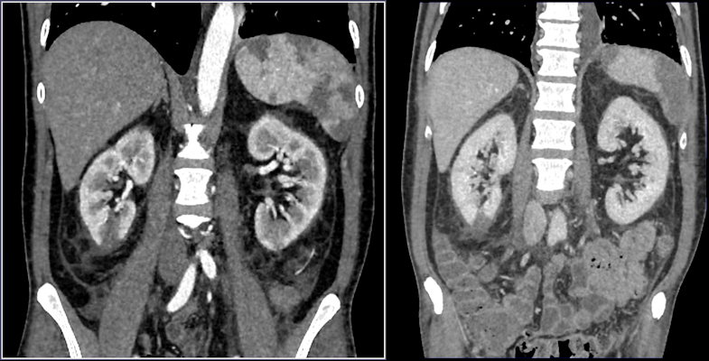 Contrast-enhanced CT shows renal vascular injury in a patient with COVID-19