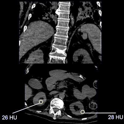 Nonenhanced CT shows renal parenchymal attenuation and edema and inflammation in COVID-19 patient