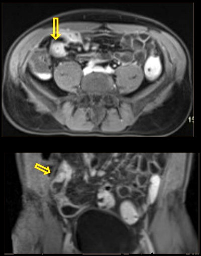 58-year-old man with a history of diffuse abdominal pain
