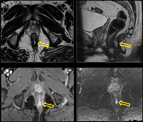 68-year-old man with rectal fistula presented for prostate screening and complained of rectal discomfort