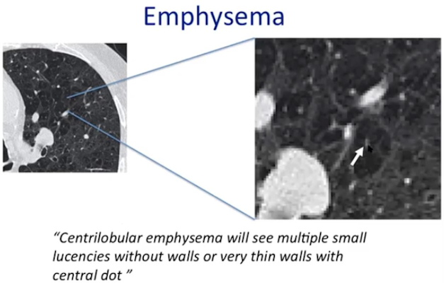 Centrilobular emphysema has no or very thin walls and a central dot