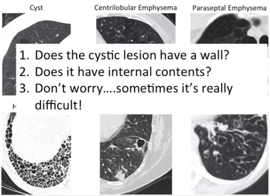 Three top tips for determining pathology in air-filled cystic lesion