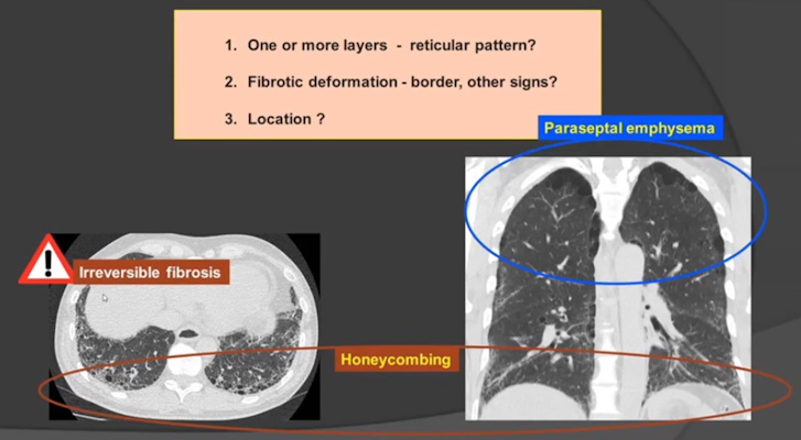 Location is the key when it comes to differentiating honeycombing from paraseptal emphysema