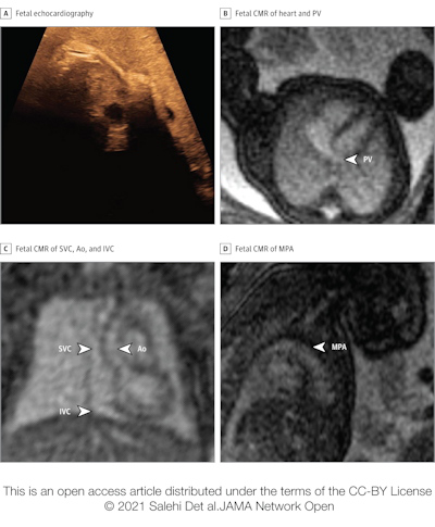 Basic assessment in a fetus with risk factors for cardiac malformation and a very poor acoustic window