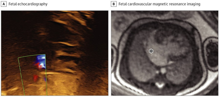 Evaluation of Atrial Restriction in a fetus with hypoplastic left heart syndrome