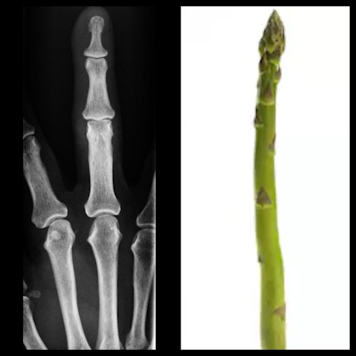 X-ray of finger, phalanx looks like an asparagus tip