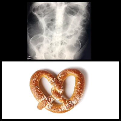 Abdominal x-ray of colon looks like a pretzel