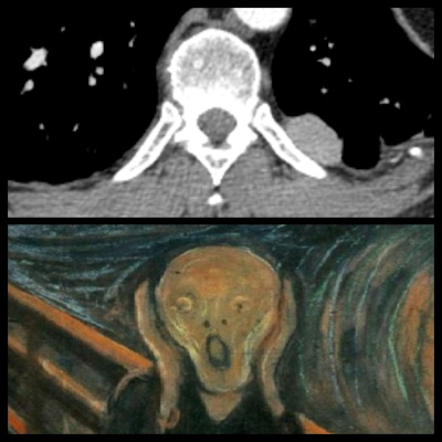 Chest CT of normal vertebra, spinal canal, and posterior ribs looks like the Scream by Edvard Munch