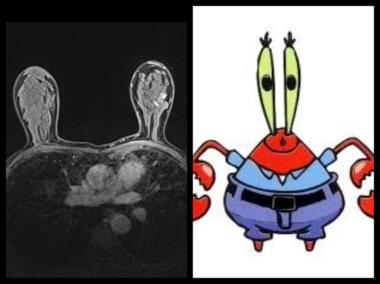 Breast MRI (axial) of breasts and thoracic cavity looks like Mr. Krabs, a character in the animated TV series SpongeBob SquarePants