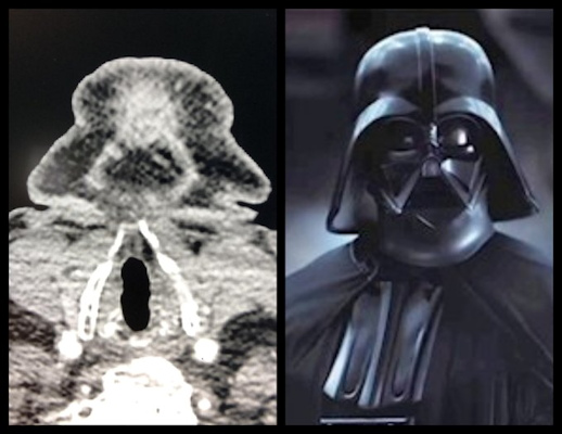 Neck CT of anterior cervical region looks like Darth Vader