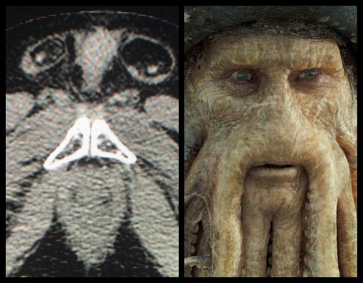 Pelvic CT of pubis, inguinal canals looks like Davy Jones from Pirates of the Caribbean