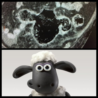 Abdominal CT and giant colonic diverticula looks like Shaun the Sheep