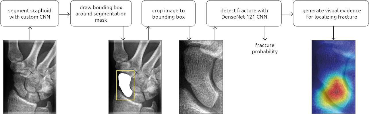 Overview of the scaphoid fracture detection pipeline, which consisted of a segmentation and detection convolutional neural network
