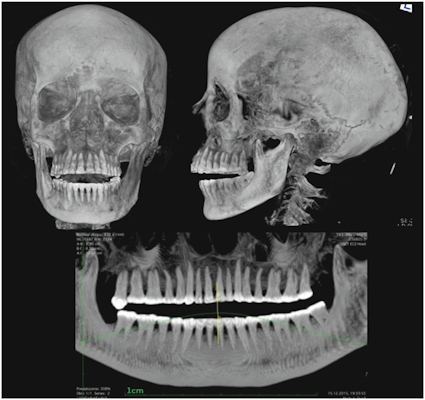 X-ray of the head and the pantomographic image of the teeth of the mummy