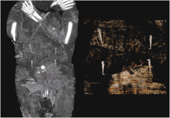 The abdominal area of the mummy with amulets representing the four sons of Horus above the navel area