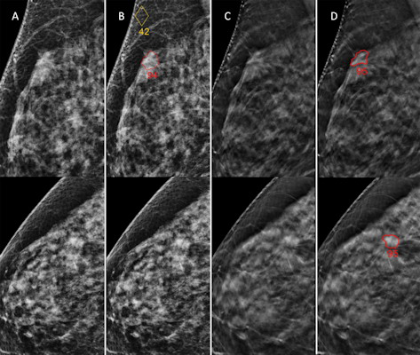 Digital mammography and digital breast tomosynthesis images in a 66-year-old woman not recalled during any of the original readings