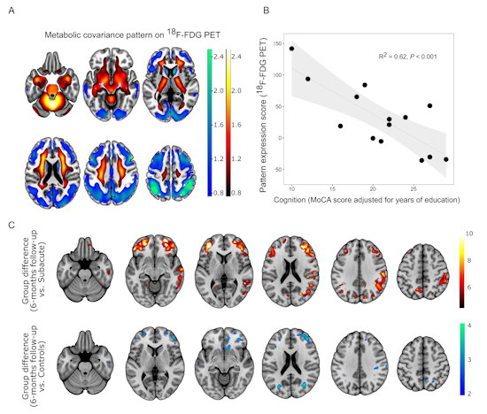 COVID-19-related spatial covariance pattern of cerebral glucose metabolism overlaid onto an MRI template