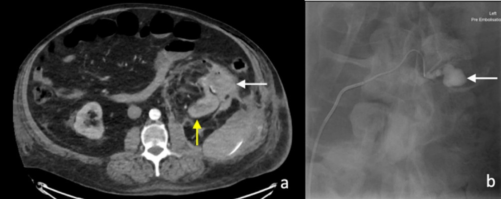 Arterial phase CT image of perinephric hematoma at the site of partial nephrectomy
