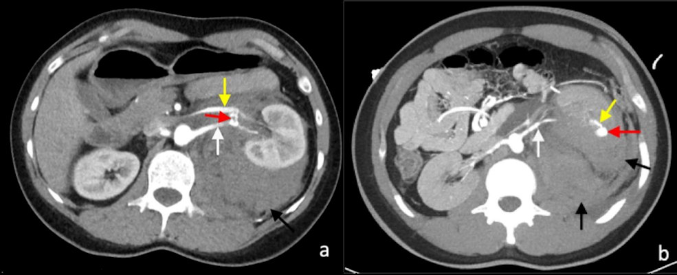 Postcontrast arterial phase axial CT images of vascular complications following nontargeted ultrasound-guided 14-gauge core biopsies of the left kidney in two patients