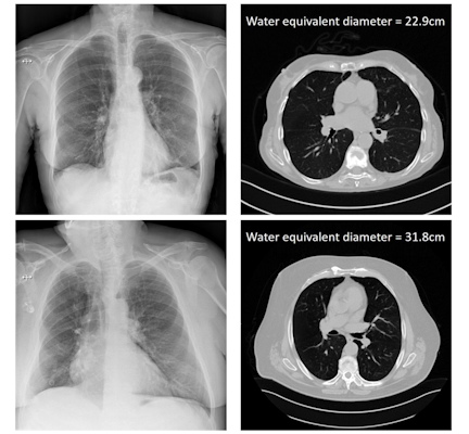 The x-ray attenuation of the patient calculated from the DICOM header information of chest x-rays, and compared with CT gold-standard size measures