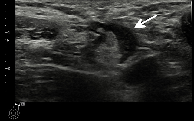 Ultrasonography of the left axilla shows an enlarged 17 mm reactive lymph node in a 45-year-old woman about a week after receiving the firrst dose of the Vaxzevria COVID-19 vaccine