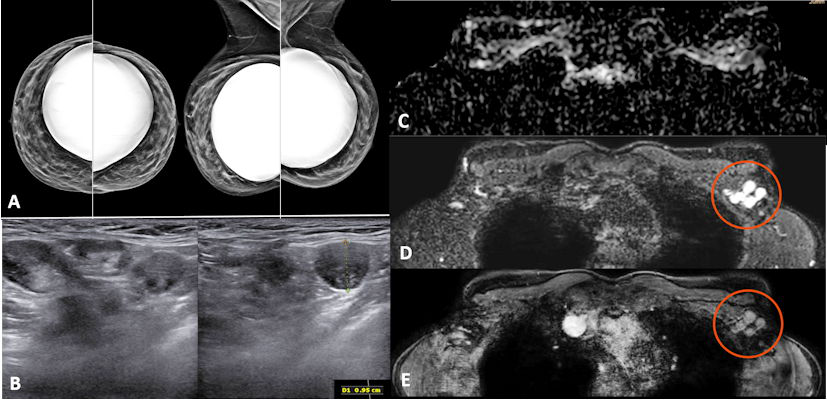 Screening mammography performed in a 44-year-old woman with a positive family history for breast cancer, bearing implants for aesthetic purposes