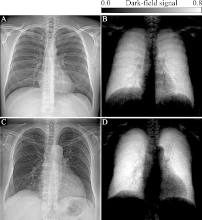 Attenuation-based (left) and dark-field (right) posteroanterior radiographs of the thorax in example subjects